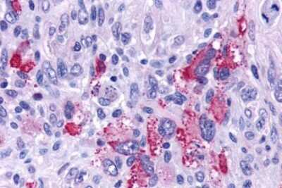 Immunohistochemistry-Paraffin: GPR162 Antibody [NLS1695] - Anti-GPR162 antibody IHC of human Brain, Glioblastoma. Immunohistochemistry of formalin-fixed, paraffin-embedded tissue after heat-induced antigen retrieval.