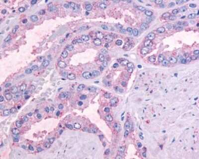 Immunohistochemistry-Paraffin: GPR164 Antibody [NLS1851] - Analysis of anti-OR51E1 antibody with human prostate, carcinoma.
