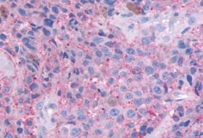 Immunohistochemistry-Paraffin: GPR164 Antibody [NLS1851] - Anti-OR51E1 antibody IHC of human Skin, Melanoma. Immunohistochemistry of formalin-fixed, paraffin-embedded tissue after heat-induced antigen retrieval.