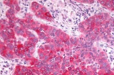 Immunohistochemistry-Paraffin: GPR17 Antibody [NLS4228] - Anti-GPR17 antibody IHC of human Lung, Non-Small Cell Carcinoma. Immunohistochemistry of formalin-fixed, paraffin-embedded tissue after heat-induced antigen retrieval.