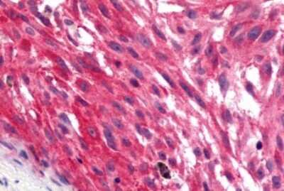 Immunohistochemistry-Paraffin: GPR17 Antibody [NLS4228] - Anti-GPR17 antibody IHC of human Skin, Melanoma. Immunohistochemistry of formalin-fixed, paraffin-embedded tissue after heat-induced antigen retrieval.