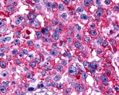 Immunohistochemistry-Paraffin: GPR175 Antibody [NLS1520] - Analysis of anti-TPRA1 / GPR175 antibody with human breast, carcinoma.