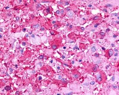 Immunohistochemistry-Paraffin: GPR175 Antibody [NLS1522] - Analysis of anti-TPRA1 / GPR175 antibody with human brain, glioblastoma.