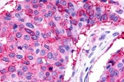 Immunohistochemistry-Paraffin: GPR175 Antibody [NLS1522] - Anti-TPRA1 / GPR175 antibody IHC of human Breast, Carcinoma. Immunohistochemistry of formalin-fixed, paraffin-embedded tissue after heat-induced antigen retrieval.
