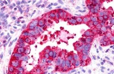 Immunohistochemistry-Paraffin: GPR175 Antibody [NLS1522] - Anti-TPRA1 / GPR175 antibody IHC of human Lung, Adenocarcinoma. Immunohistochemistry of formalin-fixed, paraffin-embedded tissue after heat-induced antigen retrieval.