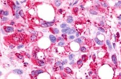 Immunohistochemistry-Paraffin: GPR175 Antibody [NLS1522] - Anti-TPRA1 / GPR175 antibody IHC of human Pancreas, Carcinoma. Immunohistochemistry of formalin-fixed, paraffin-embedded tissue after heat-induced antigen retrieval.