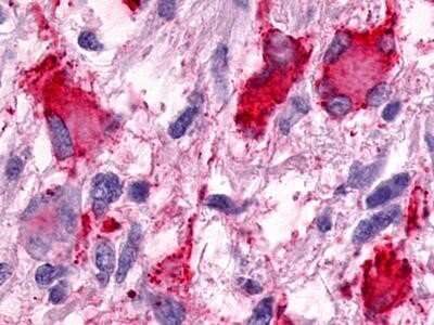 Immunohistochemistry-Paraffin: GPR25 Antibody [NLS483] - Analysis of anti-GPR25 antibody with human brain, glioblastoma at dilution 1-2 ug/ml.
