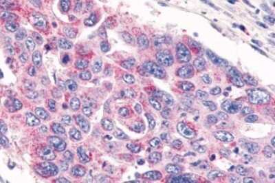Immunohistochemistry-Paraffin: GPR26 Antibody [NLS4112] - Anti-GPR26 antibody IHC of human Colon, Carcinoma. Immunohistochemistry of formalin-fixed, paraffin-embedded tissue after heat-induced antigen retrieval.