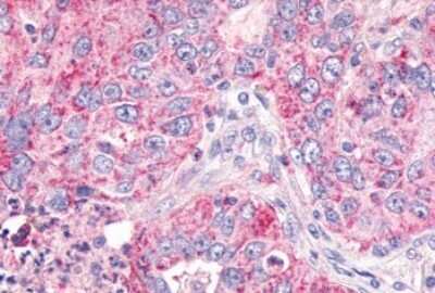 Immunohistochemistry-Paraffin: GPR26 Antibody [NLS4112] - Anti-GPR26 antibody IHC of human Lung, Non-Small Cell Carcinoma. Immunohistochemistry of formalin-fixed, paraffin-embedded tissue after heat-induced antigen retrieval.