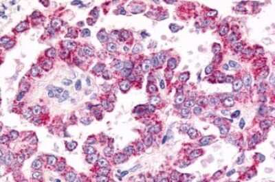 Immunohistochemistry-Paraffin: GPR26 Antibody [NLS4112] - Anti-GPR26 antibody IHC of human Ovary, Carcinoma. Immunohistochemistry of formalin-fixed, paraffin-embedded tissue after heat-induced antigen retrieval.