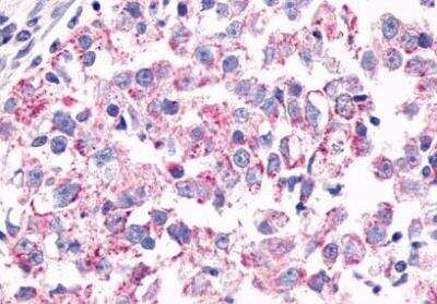 Immunohistochemistry-Paraffin: GPR26 Antibody [NLS4112] - Breast, Carcinoma