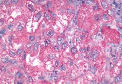 Immunohistochemistry-Paraffin: GPR27 Antibody [NLS496] - Human Lung, Non-Small Cell Carcinoma. Formalin-fixed, paraffin-embedded tissue after heat-induced antigen retrieval.
