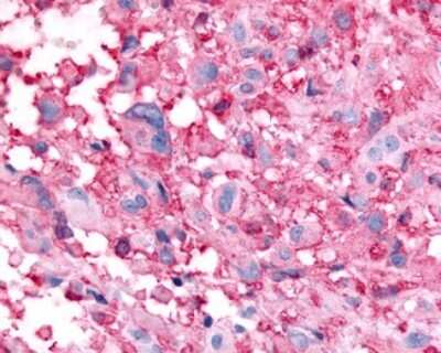 Immunohistochemistry-Paraffin: GPR32 Antibody [NLS4889] - Analysis of anti-GPR32 antibody with human brain, glioblastoma.