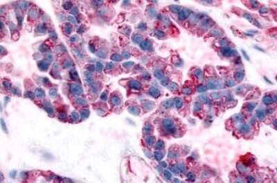 Immunohistochemistry-Paraffin: GPR32 Antibody [NLS4889] - Anti-GPR32 antibody IHC of human Ovary, Carcinoma. Immunohistochemistry of formalin-fixed, paraffin-embedded tissue after heat-induced antigen retrieval.