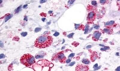 Immunohistochemistry-Paraffin: GPR34 Antibody [NLS1259] - Anti-GPR34 antibody IHC of human Soft Tissue, Liposarcoma. Immunohistochemistry of formalin-fixed, paraffin-embedded tissue after heat-induced antigen retrieval.
