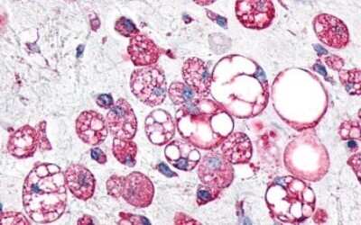 Immunohistochemistry-Paraffin: GPR34 Antibody [NLS1259] - Anti-GPR34 antibody IHC of human Soft Tissue, Liposarcoma. Immunohistochemistry of formalin-fixed, paraffin-embedded tissue after heat-induced antigen retrieval.