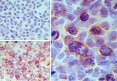 Immunohistochemistry-Paraffin: GPR35 Antibody [NBP2-24640] - Analysis of GPR35 in paraffin-embedded formalin-fixed MCF7cells using an isotype control (top left) and NBP2-24640 (bottom left, right) at 5 ug/ml.