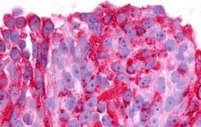 Immunohistochemistry-Paraffin: GPR37 Antibody [NLS129] - Anti-PAEL Receptor / GPR37 antibody IHC of human Ovary, Carcinoma. Immunohistochemistry of formalin-fixed, paraffin-embedded tissue after heat-induced antigen retrieval.