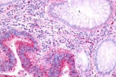 Immunohistochemistry-Paraffin: GPR37 Antibody [NLS129] - Anti-PAEL Receptor / GPR37 antibody IHC of human Colon, Carcinoma. Immunohistochemistry of formalin-fixed, paraffin-embedded tissue after heat-induced antigen retrieval.