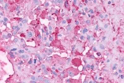 Immunohistochemistry-Paraffin: GPR37 Antibody [NLS129] - Anti-PAEL Receptor / GPR37 antibody IHC of human Brain, Glioblastoma. Immunohistochemistry of formalin-fixed, paraffin-embedded tissue after heat-induced antigen retrieval.