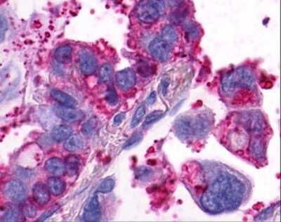Immunohistochemistry-Paraffin: GPR4 Antibody [NLS143] - Analysis of anti-GPR4 antibody with human lung, adenocarcinoma.