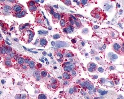 Immunohistochemistry-Paraffin: GPR4 Antibody [NLS144] - Analysis of anti-GPR4 antibody with human lung, adenocarcinoma.