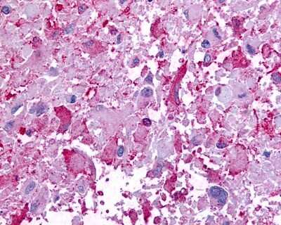 Immunohistochemistry-Paraffin: GPR45 Antibody [NLS1227] - Analysis of anti-GPR45 antibody with human brain, glioblastoma.