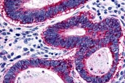Immunohistochemistry-Paraffin: GPR45 Antibody [NLS1227] - Anti-GPR45 antibody IHC of human Colon, Carcinoma. Immunohistochemistry of formalin-fixed, paraffin-embedded tissue after heat-induced antigen retrieval.