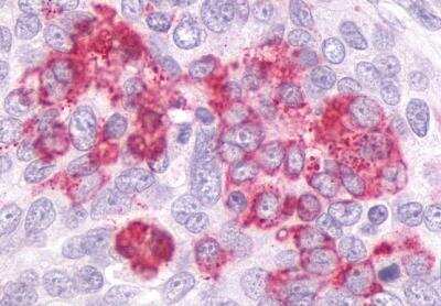 Immunohistochemistry-Paraffin: GPR55 Antibody [NLS6817] - Analysis of anti-GPR55 antibody with human ovary, carcinoma.