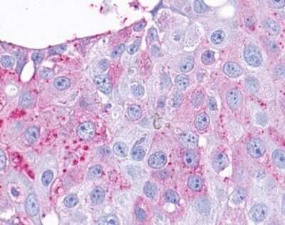 Immunohistochemistry-Paraffin: GPR57 Antibody [NLS2573] - Analysis of anti-TAAR9 antibody with human breast, carcinoma.