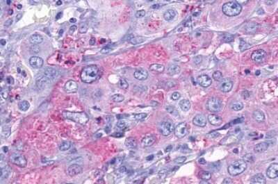 Immunohistochemistry-Paraffin: GPR57 Antibody [NLS2573] - Anti-TAAR9 antibody IHC of human Lung, Adenocarcinoma. Immunohistochemistry of formalin-fixed, paraffin-embedded tissue after heat-induced antigen retrieval.