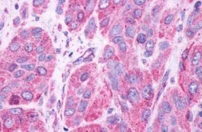 Immunohistochemistry-Paraffin: GPR61 Antibody [NLS1685] - Anti-GPR61 antibody IHC of human Skin, Melanoma. Immunohistochemistry of formalin-fixed, paraffin-embedded tissue after heat-induced antigen retrieval.