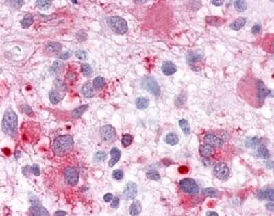 Immunohistochemistry-Paraffin: GPR63 Antibody [NLS6379] - Analysis of anti-GPR63 antibody with human brain, glioblastoma.