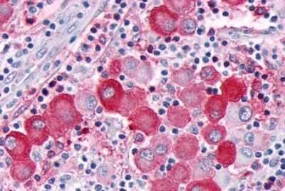 Immunohistochemistry-Paraffin: GPR63 Antibody [NLS6379] - Anti-GPR63 antibody IHC of human Skin, Melanoma. Immunohistochemistry of formalin-fixed, paraffin-embedded tissue after heat-induced antigen retrieval.