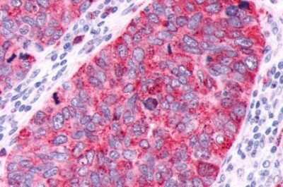 Immunohistochemistry-Paraffin: GPR63 Antibody [NLS6379] - Anti-GPR63 antibody IHC of human Lung, Small Cell Carcinoma. Immunohistochemistry of formalin-fixed, paraffin-embedded tissue after heat-induced antigen retrieval.