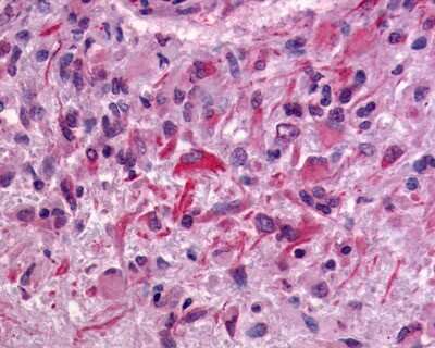 Immunohistochemistry-Paraffin: GPR64 Antibody [NLS1262] - Analysis of anti-GPR64 antibody with human brain, glioblastoma.