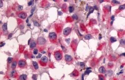 Immunohistochemistry-Paraffin: GPR64 Antibody [NLS1262] - Anti-GPR64 antibody IHC of human Skin, Melanoma. Immunohistochemistry of formalin-fixed, paraffin-embedded tissue after heat-induced antigen retrieval.