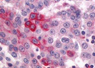 Immunohistochemistry-Paraffin: GPR64 Antibody [NLS1262] - Lung, Adenocarcinoma