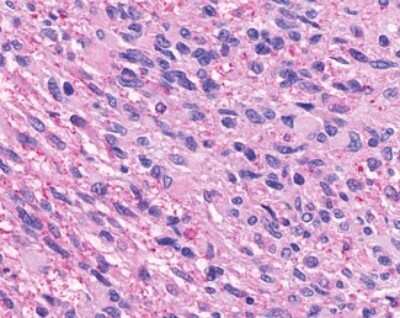 Immunohistochemistry-Paraffin: GPR74/NPFFR2 Antibody [NLS3302] - Analysis of anti-NPFF2 / NPFFR2 antibody with human brain, glioblastoma.