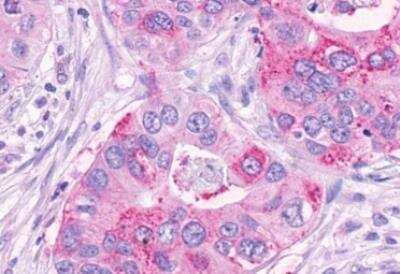 Immunohistochemistry-Paraffin: GPR74/NPFFR2 Antibody [NLS3302] - Human Pancreas, Carcinoma paraffin-embedded tissue after heat-induced antigen retrieval.