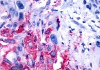 Immunohistochemistry-Paraffin: GPR8 Antibody [NLS175] - Anti-NPBWR2 / GPR8 antibody IHC of human Pancreas, Carcinoma. Immunohistochemistry of formalin-fixed, paraffin-embedded tissue after heat-induced antigen retrieval.