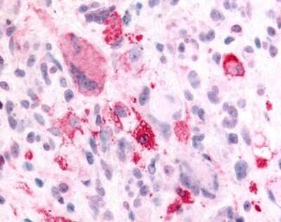 Immunohistochemistry-Paraffin: GPR8 Antibody [NLS6636] - Analysis of anti-NPBWR2 / GPR8 antibody with human brain, glioblastoma.