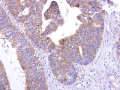 Immunohistochemistry-Paraffin: GPR82 Antibody [NBP2-16725] - GPR82 antibody detects GPR82 protein at cytosol on human colon carcinoma by immunohistochemical analysis. Sample: GPR82 antibody dilution: 1:250.