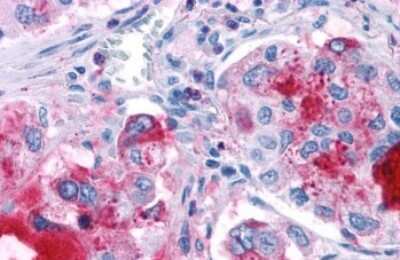 Immunohistochemistry-Paraffin: GPR82 Antibody [NLS2706] - Anti-GPR82 antibody IHC of human Lung, Adenocarcinoma. Immunohistochemistry of formalin-fixed, paraffin-embedded tissue after heat-induced antigen retrieval.