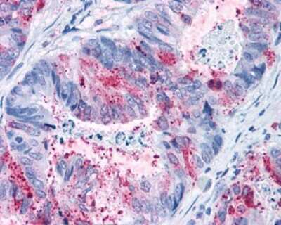 Immunohistochemistry-Paraffin: GPR82 Antibody [NLS2707] - Analysis of anti-GPR82 antibody with human colon, carcinoma.