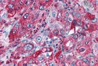 Immunohistochemistry-Paraffin: GPR82 Antibody [NLS2707] - Anti-GPR82 antibody IHC of human Lung, Adenocarcinoma. Immunohistochemistry of formalin-fixed, paraffin-embedded tissue after heat-induced antigen retrieval.