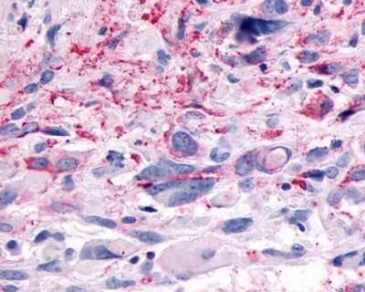 Immunohistochemistry-Paraffin: GPR83 Antibody [NLS4957] - Analysis of anti-GPR83 antibody with human brain, glioblastoma.