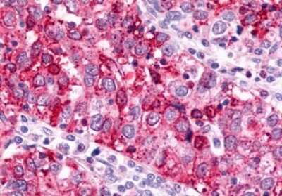 Immunohistochemistry-Paraffin: GPR88 Antibody [NLS6324] - Anti-GPR88 antibody IHC of human Ovary, Carcinoma. Immunohistochemistry of formalin-fixed, paraffin-embedded tissue after heat-induced antigen retrieval.