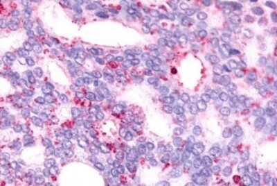 Immunohistochemistry-Paraffin: GPR88 Antibody [NLS6324] - Anti-GPR88 antibody IHC of human Prostate, Carcinoma. Immunohistochemistry of formalin-fixed, paraffin-embedded tissue after heat-induced antigen retrieval.