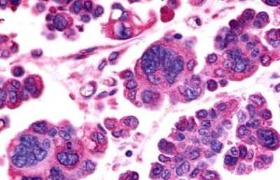 Immunohistochemistry-Paraffin: GPR98 Antibody [NLS1727] - Anti-GPR98 / VLGR1 antibody IHC of human Ovary, Carcinoma. Immunohistochemistry of formalin-fixed, paraffin-embedded tissue after heat-induced antigen retrieval.